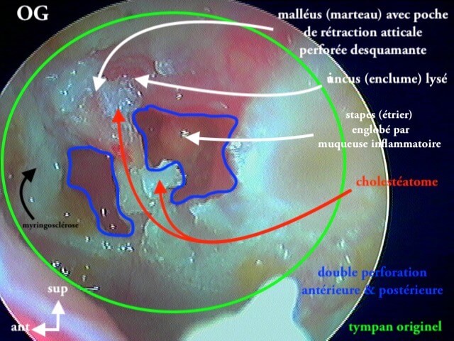 101 216 Cholestéatome total OG légende de 101 215 A