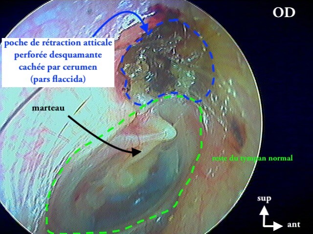 101 219 Cholestéatome attical OD légende de 101 218