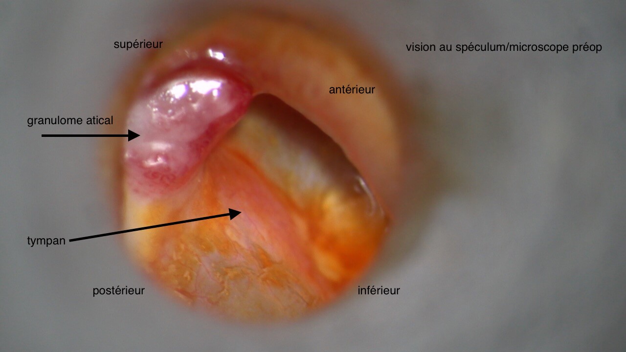 101 223 cholestéatome chir OD Préop granulome suite de 101 221