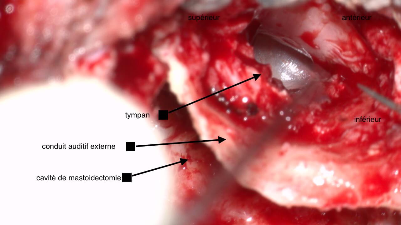 101 224 cholestéatome chir OD suite de 101 221