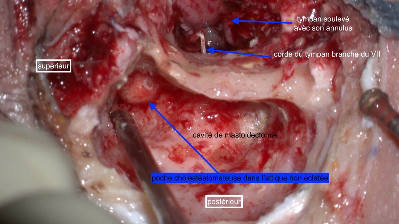 101 225 cholestéatome chir OD chole attical suite de 101 221