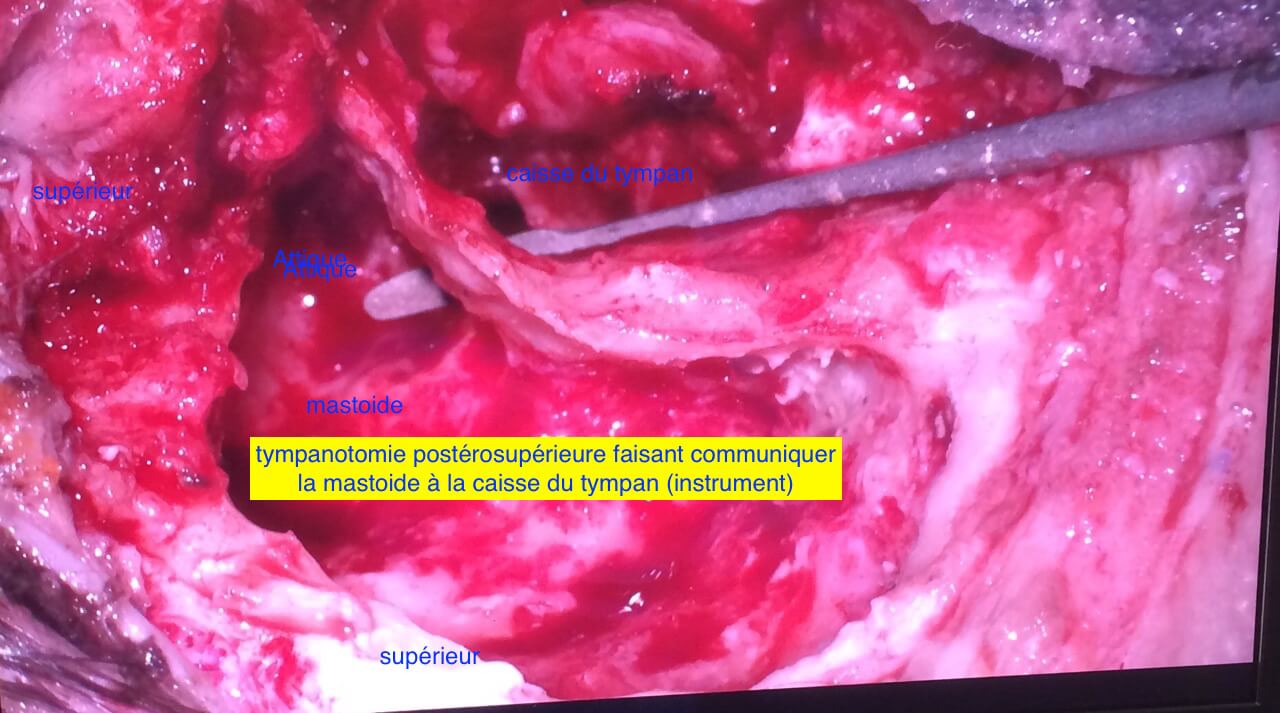 101 226 cholestéatome chir OD Tympanotomie postérieure suite de 101 221