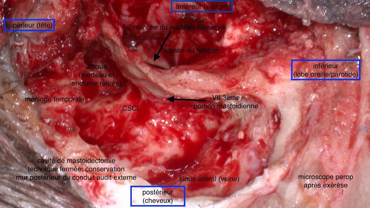 101 227 cholestéatome chir OD après exérèse suite de 101 221 