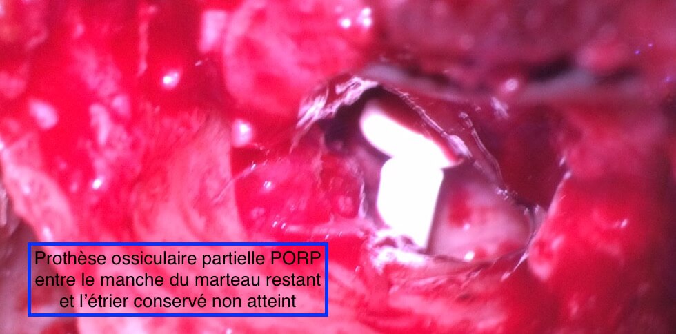 101 228 cholestéatome chir OD ossiculoplastiePORP