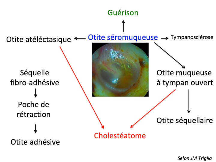 101 234 Mécanismes oreille moyenne chronique