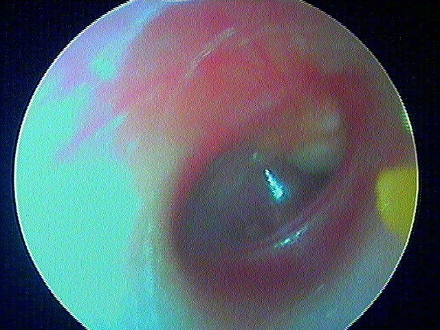 102 235 chole congénital OD
