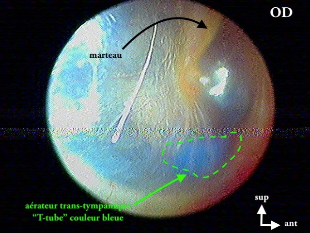 11 245 ATT rétorauriculaire OD légende 11 244