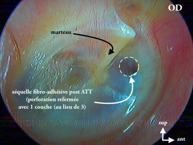 11 251 perfo droite refermée postATT suite de 11 249