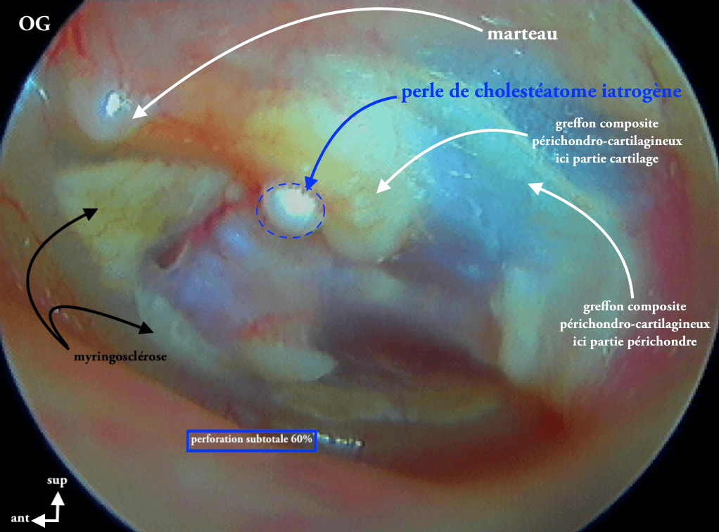 11 263 Perle chole iatrogène post myringoplastie cartilag gauche légende de 11 262