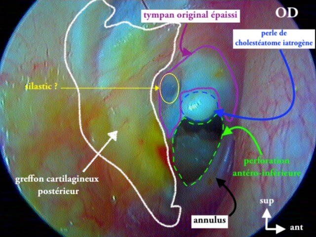 11 265 echec myringo Perfo perle OMC OD légende de 11 264