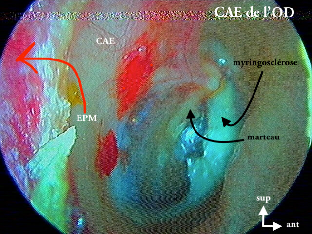 11 270 EPM OD suite de 11 269