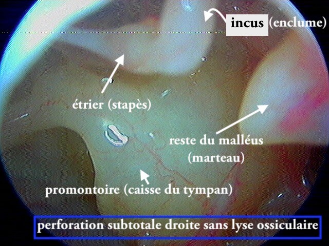 12 10 articulation incudostapédienne1