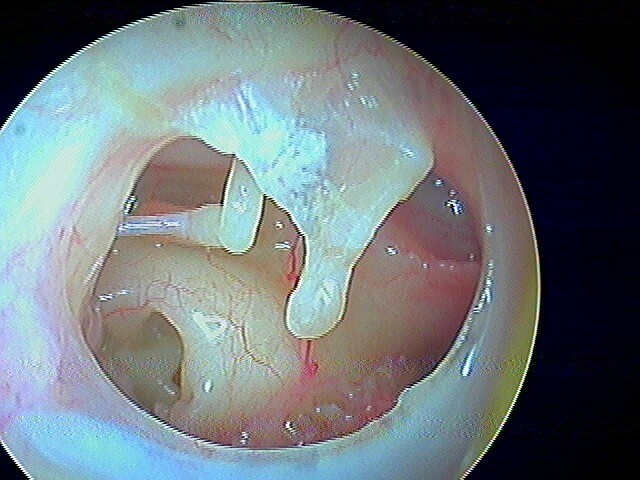 12 11 articulation uncudostapédienne