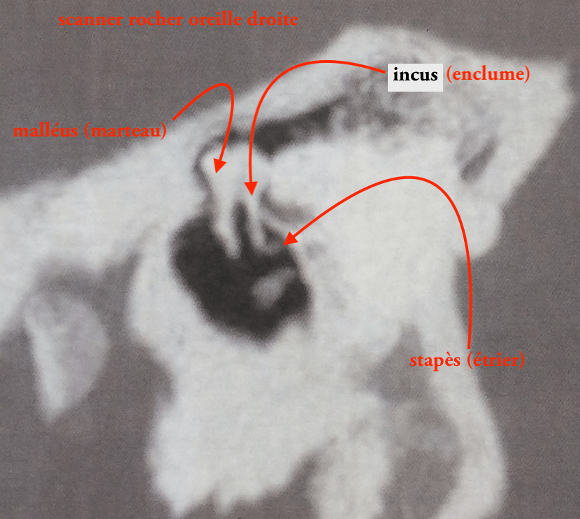 12 12B scan malleus icus légende de