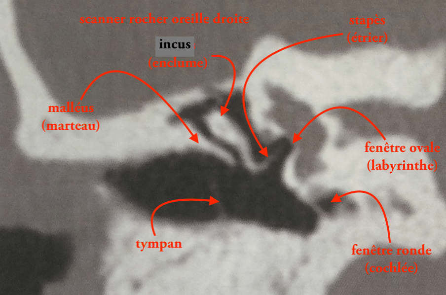 12 12D scanner incus stapes légende de 12 12C 1