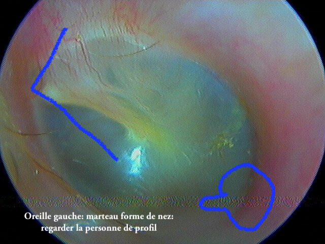 12 4 OG normale côté forme de nez avec légende