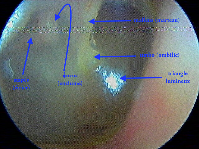 Examen Minutieux De L'oreille Des Enfants Avec Otoscope. Otoscopie