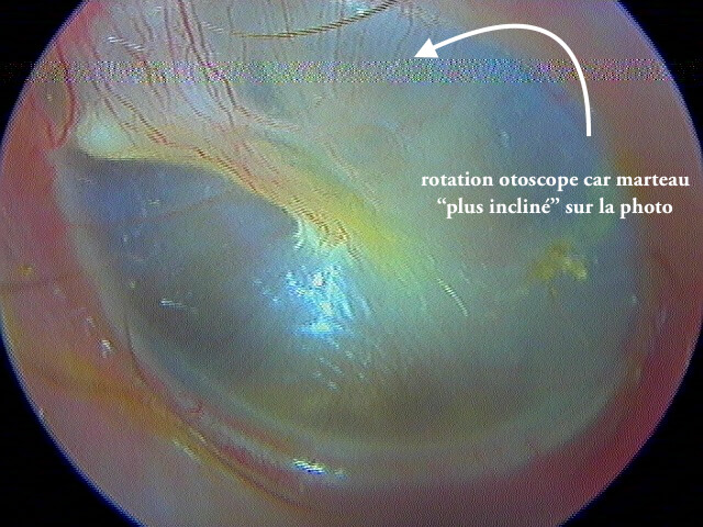 Examen En Gros Plan De L'oreille De L'enfant Avec Otoscope