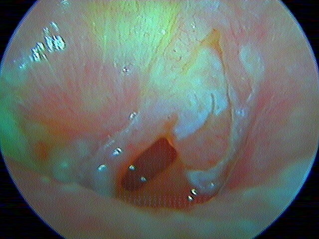 14 52 otorrhée OG après aspi suite de 13 51