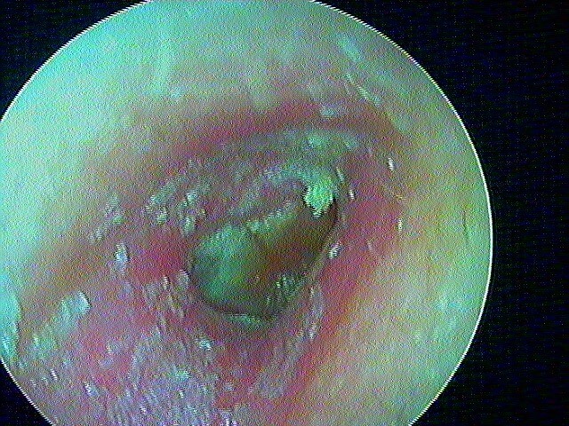 24 80 otite externe phlegmoneuse droite après ablation pop