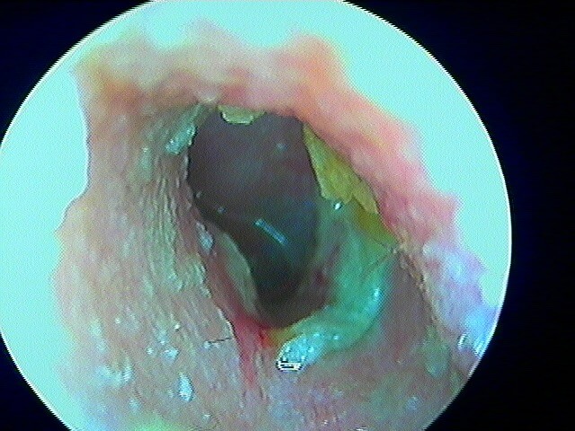 24 81 otite externe phlegmoneuse gauche après ablation pop 