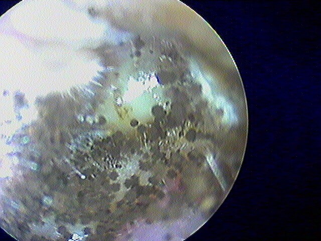 25 82 otomycose droite à Aspergillus niger