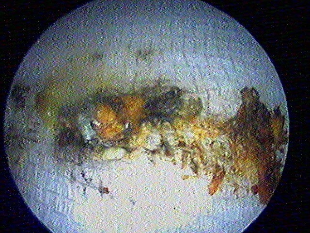 25 83 otomycose aspergillus niger suite de 25 82