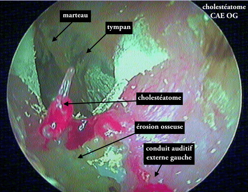 26 89 cholestéatome CAE OG avec légendes suite de 26 88