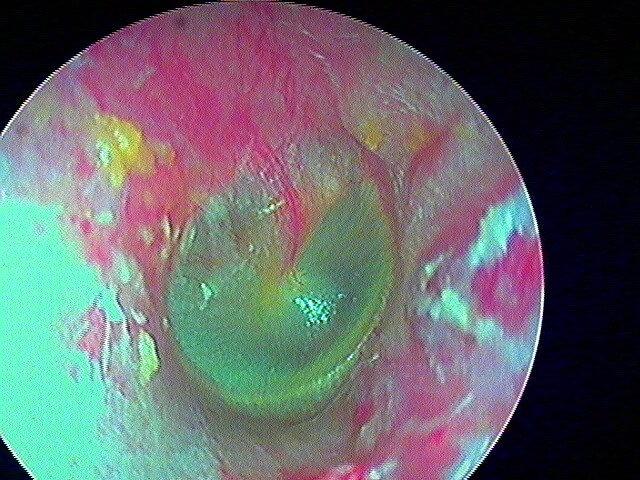 27 105 embout audioprothèse CAE OD suite de 27 103