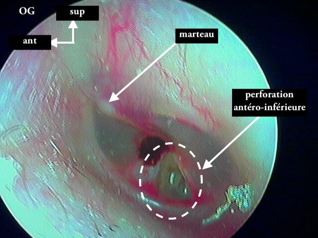 31 112 Perfo antéro inférieure OG post trauma J0 suite de 31 111