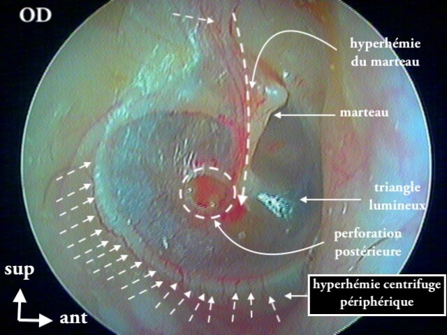 33 120 Perfo tymp OD post trauma suite de 3119 avec légendes