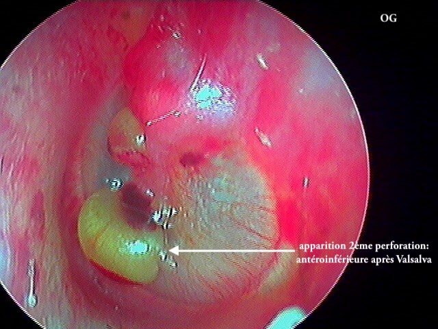 34 128 OSM OG perforée laprès Valsalva
