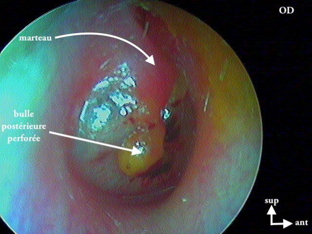 4 157 Myringite bulleuse OD avant aspir
