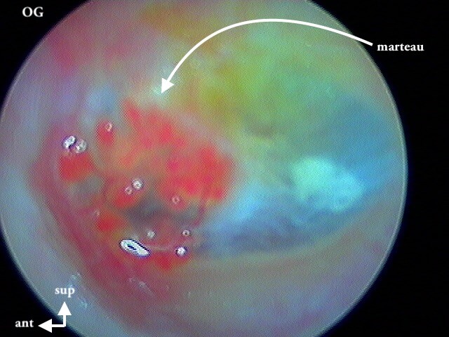 4 161 vésicules tympan myringite virale