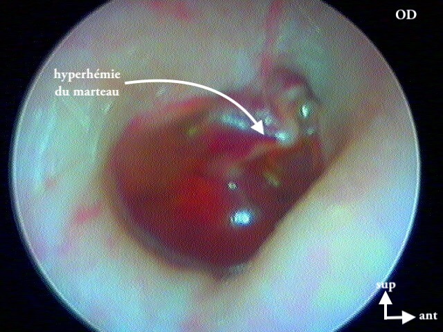 5 180 otite barotraumatique OD