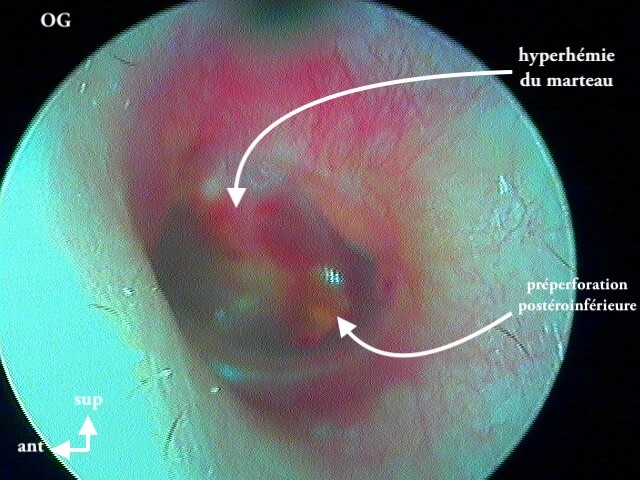 5 181 otite barotraumatique préoperforée OG