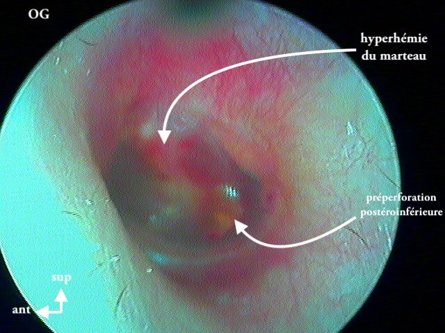 5 181 otite barotraumatique préoperforée OG