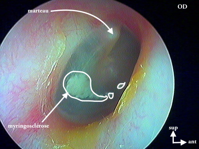 7 188 Myringosclérose droite légende de 7 187