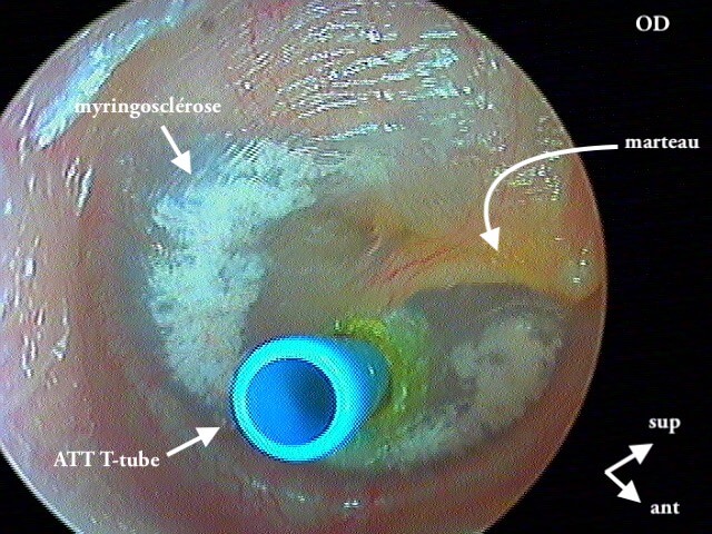 7 192 ATT Tube OD myringosclérose