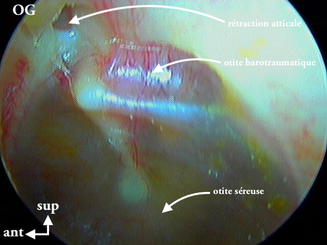 8 197 otite barotraumatique gauche sur PdR I suite de 8 195