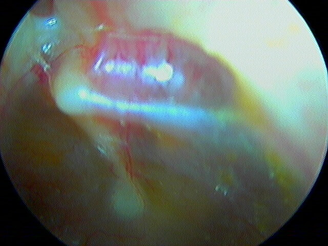 8 196 otite barotraumatique gauche sur PdR I suite de 8 195