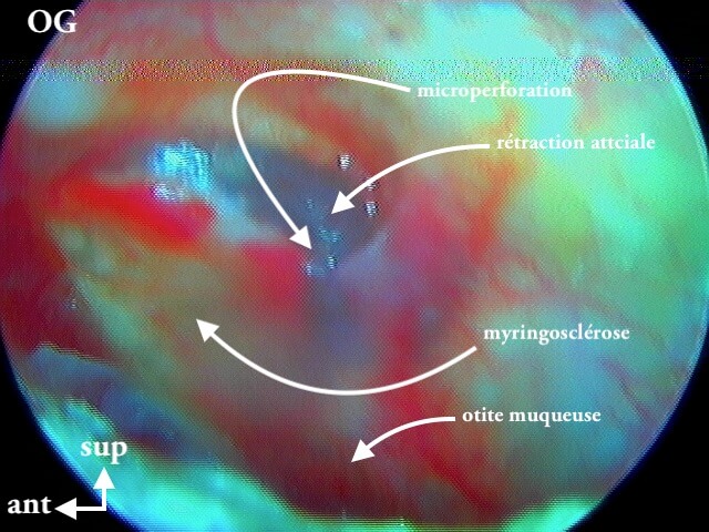9 208 OMC OG myringo microperfo non visible