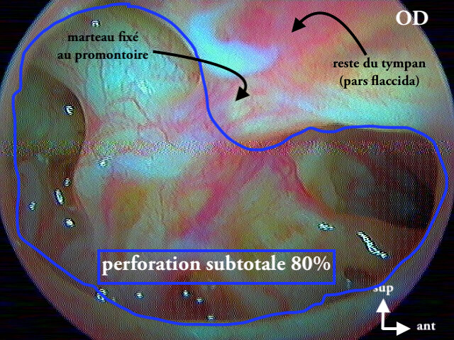 9 210 perforation subtotale droite OMC légende de 9 209