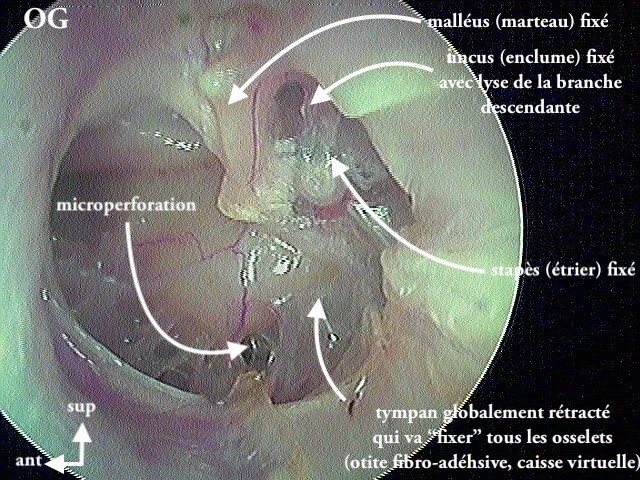 9 214 otite fibroadhésive éclatée OMC légende de 9 213A