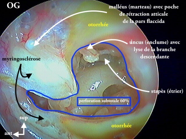 9 212 Perfo subtotale lyse BdE légende de 9 211 11