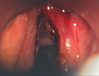 Laser cordes vocales myxœdème laryngé