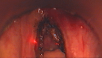 Laser cordes vocales myxœdème laryngé