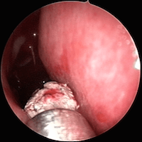 chirurgie sinus maxillaire droit aspergillome