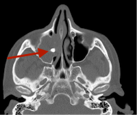scanner sinus Aspergillome maxillaire droit aspect corps étranger