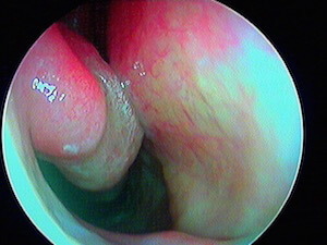 cornet nasal inférieur droit après décongestionnant